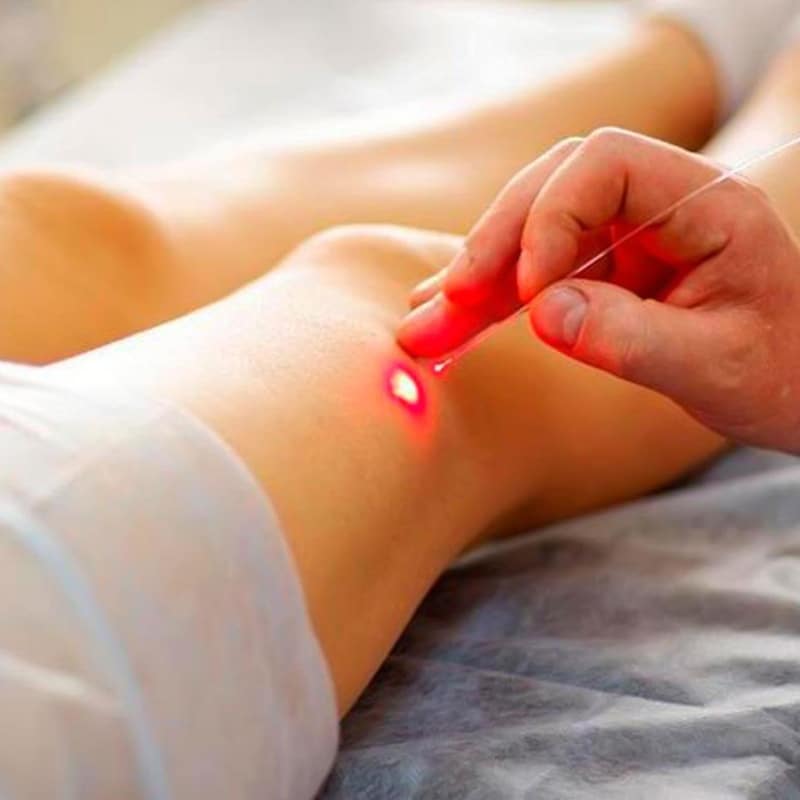 Laser Endovenoso
